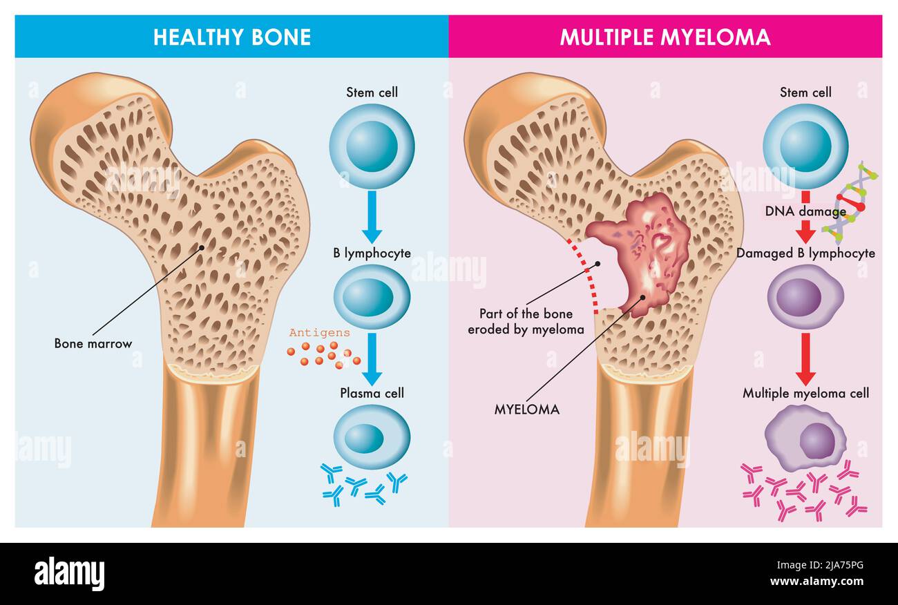 Die medizinische Illustration zeigt den Unterschied zwischen gesundem Knochen und einem Knochen, der durch ein multiples Myelom, das durch beschädigte DNA verursacht wird, erodiert wird. Stock Vektor