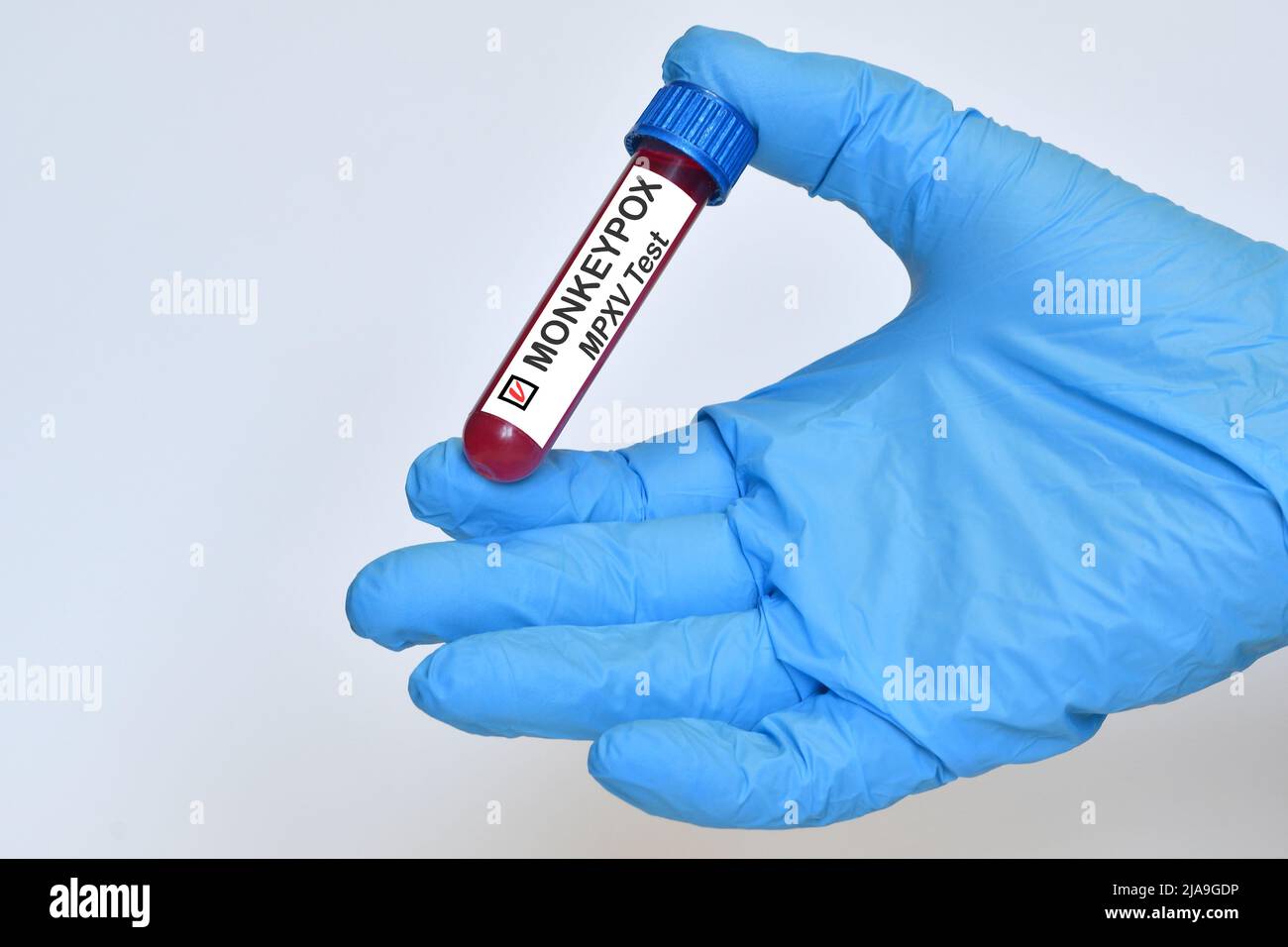 Arzt, der mit dem Monkeypox-Virus infiziertes Blut in einem Reagenzglas hält. Monkeypox-Virus (MPXV)-Konzept. Stockfoto