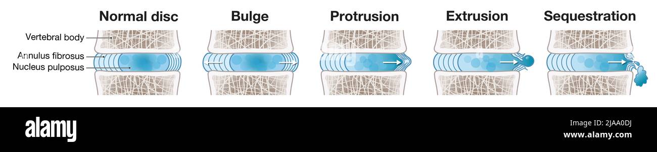Abbildung zeigt das Schema des Bandscheibenvorfalls. Normale Disc. Ausbuchtung. Vorsprung. Extrusion. Sequestrierung. Beschriftete Abbildung Stockfoto