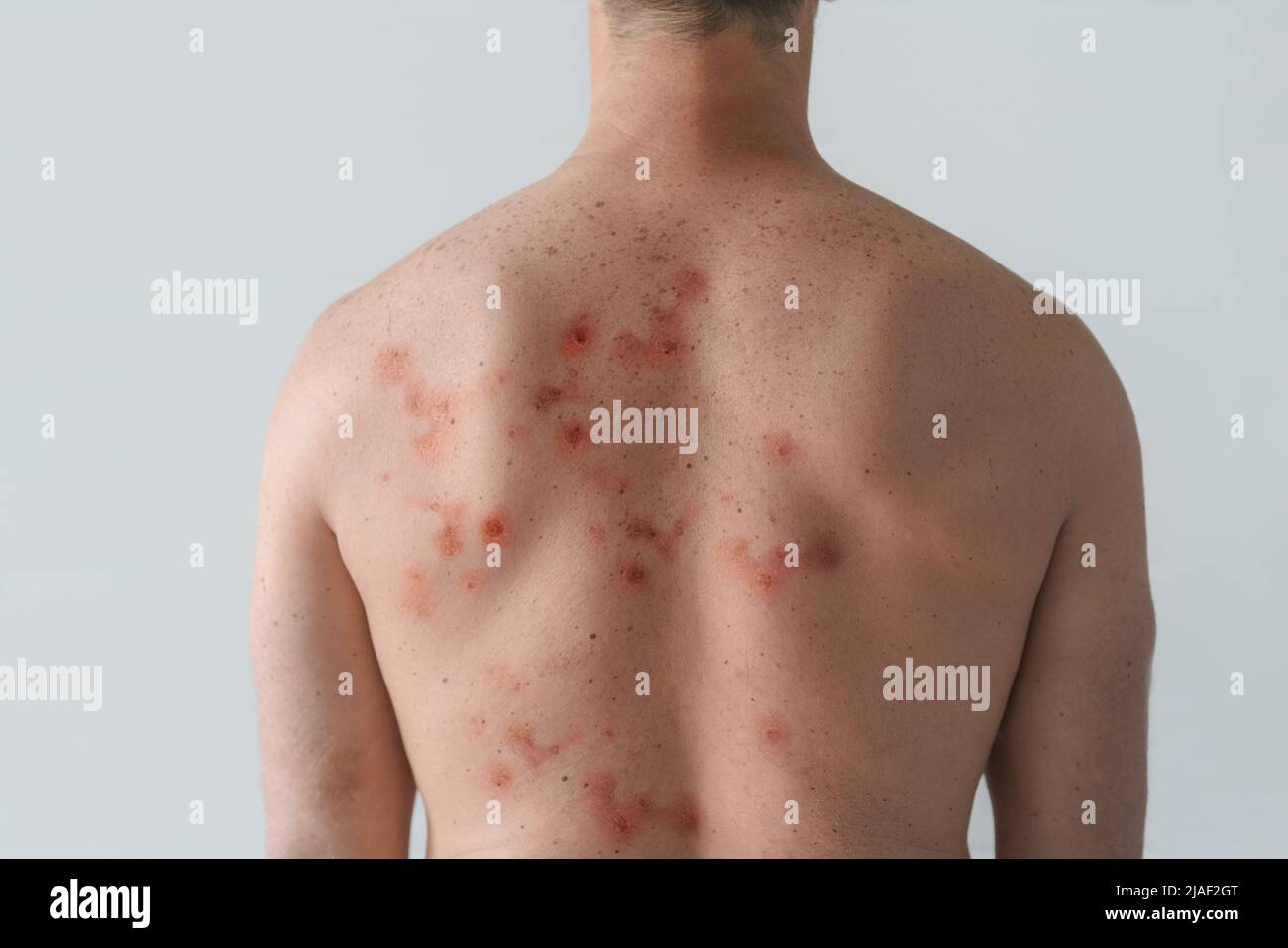 Männlicher Rücken durch Blasenausschlag aufgrund von Monkeypox oder einer anderen Virusinfektion auf weißem Hintergrund betroffen Stockfoto