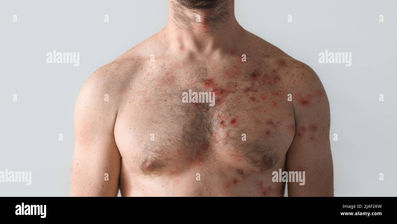 Männliche Brust durch Blasenausschlag wegen Monkeypox oder andere Virusinfektion auf weißem Hintergrund betroffen Stockfoto