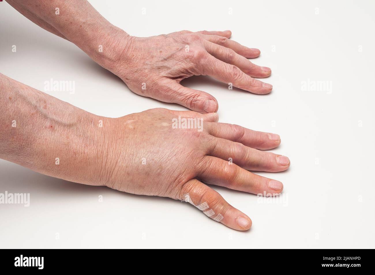 Geschwollene rechte postoperative Hand aus Dupuytrens Kontraktur mit verheilter linker postoperiverer Hand, Handflächen nach unten. Kleiner Finger auf der rechten Hand zeigt Steri-Streifen. Stockfoto