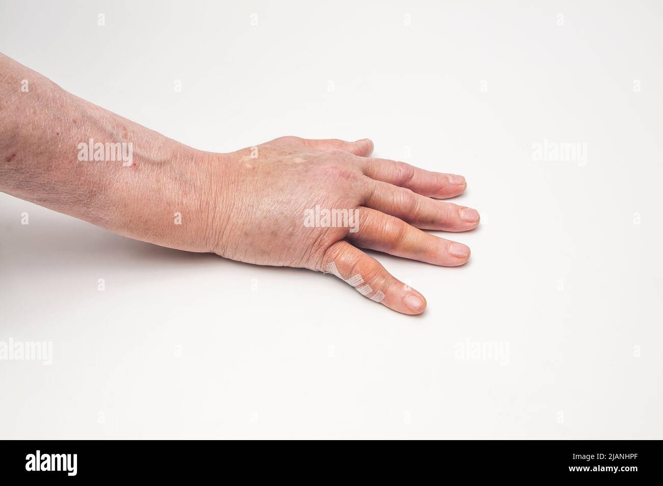 Geschwollene rechte Hand nach dem Op von Dupuytrens Kontraktur-Handfläche nach unten, mit Steristreifen. Stockfoto