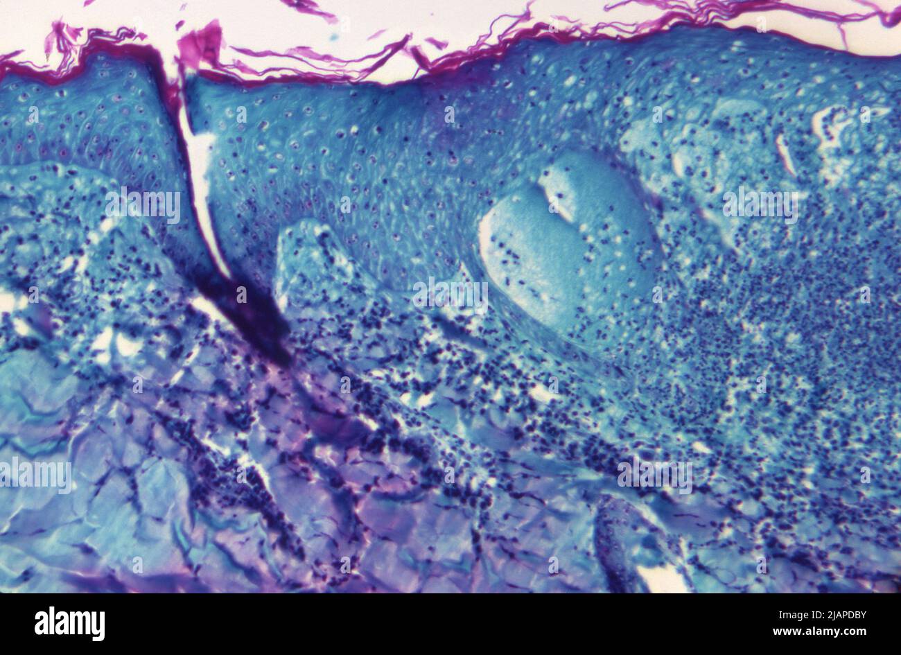 Unter einer Vergrößerung von 125X zeigte dieses Bild einen Abschnitt von Hautgewebe, der von einer Läsion auf der Haut eines Affen gewonnen wurde, die mit dem Monkeypox-Virus infiziert war. Die Probe wurde am 4. Tag der Hautausschlag-Entwicklung gewonnen. Eine optimierte und verbesserte Version eines Bildes, das von den US Centers for Disease Control and Prevention / Credit CDC erstellt wurde Stockfoto Unter einer Vergrößerung von 125X zeigte dieses Bild einen Abschnitt von Hautgewebe, der von einer Läsion auf der Haut eines Affen gewonnen wurde, die mit dem Monkeypox-Virus infiziert war. Die Probe wurde am 4. Tag der Hautausschlag-Entwicklung gewonnen. Eine optimierte und verbesserte Version eines Bildes, das von den US Centers for Disease Control and Prevention / Credit CDC erstellt wurde Stockfoto