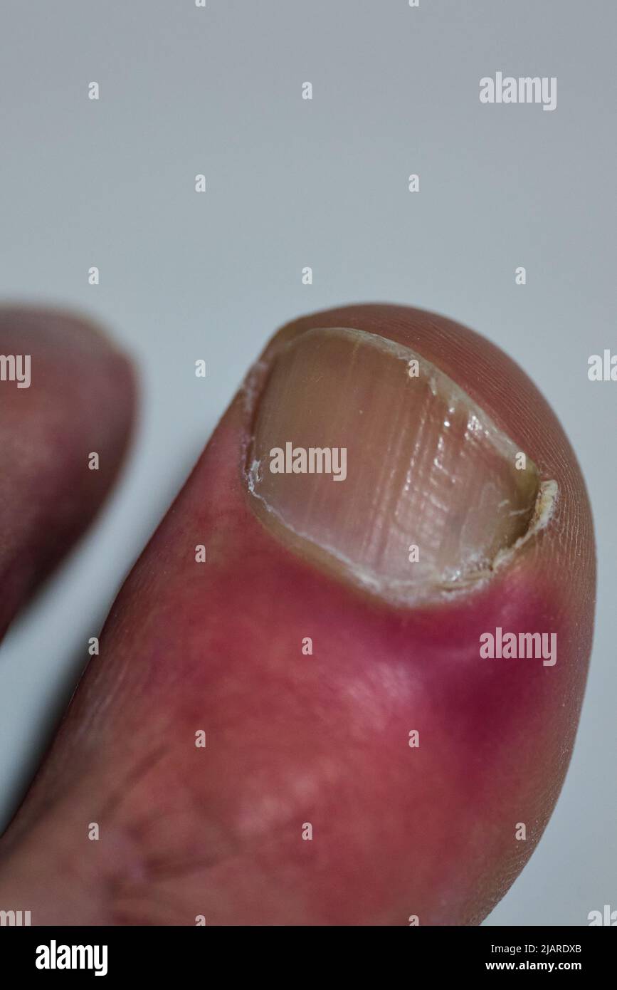 Infektion neben dem Nagel, im Zeh eines Patienten Stockfoto