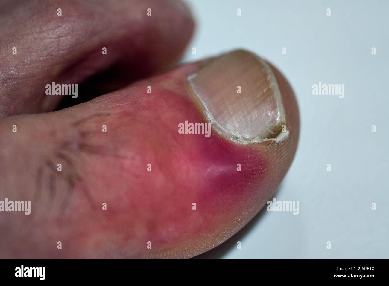 Infektion neben dem Nagel, im Zeh eines Patienten Stockfoto