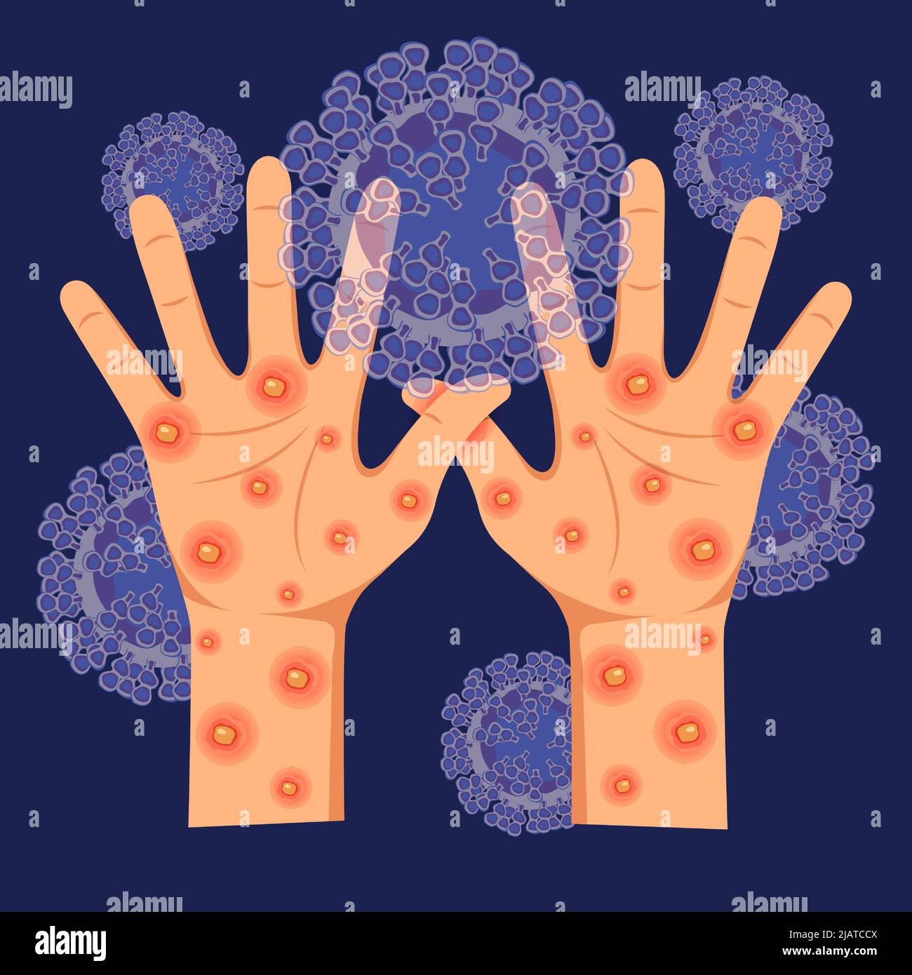 Menschliche Hände mit Monkeypox-Virus auf dem mikroskopischen Hintergrund des Virus. Vektordarstellung von Monkeypox. Hautinfektion. Virussymptome. Stock Vektor