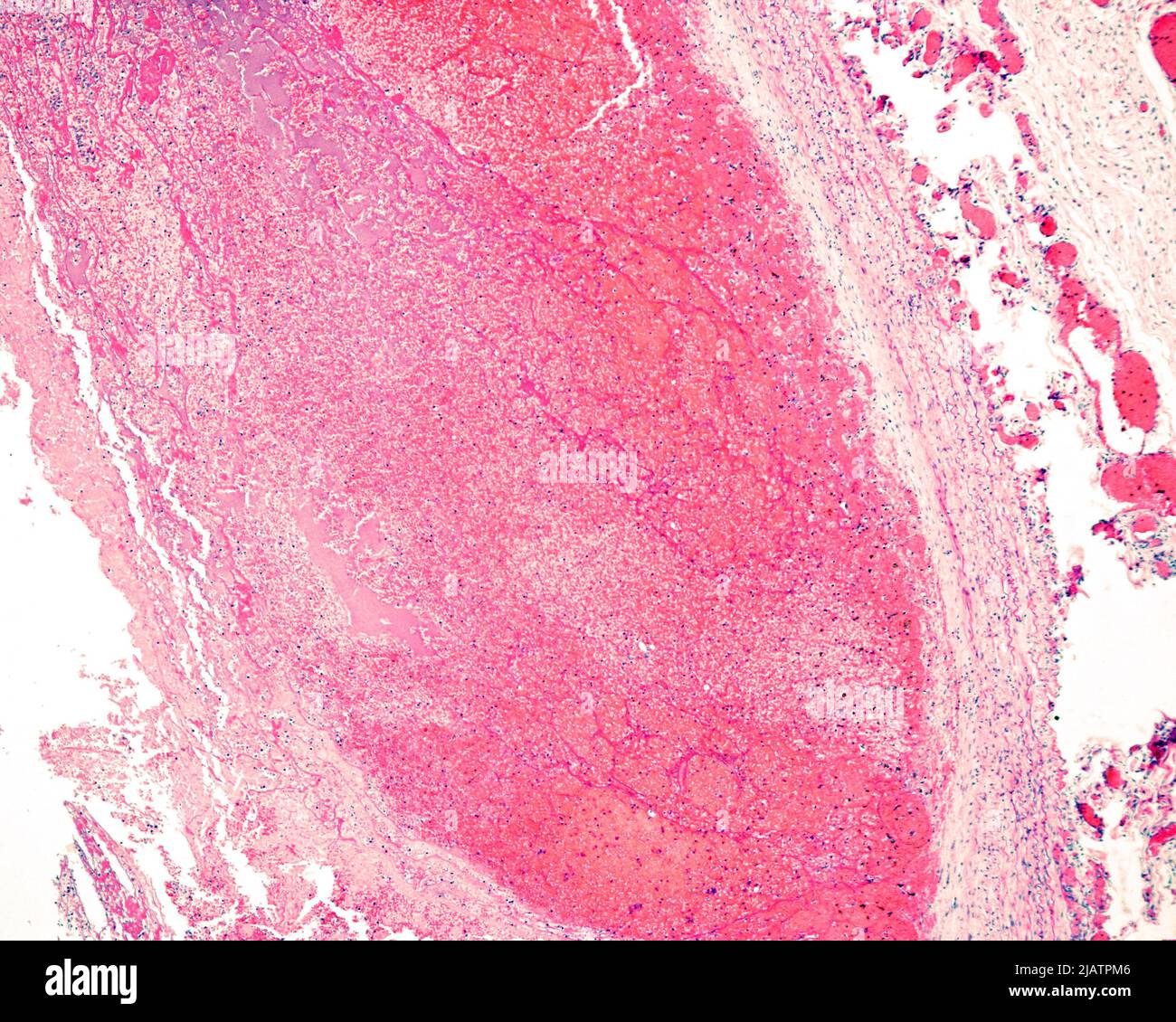 Arterielle Thrombose, leichte Mikrographie Stockfoto
