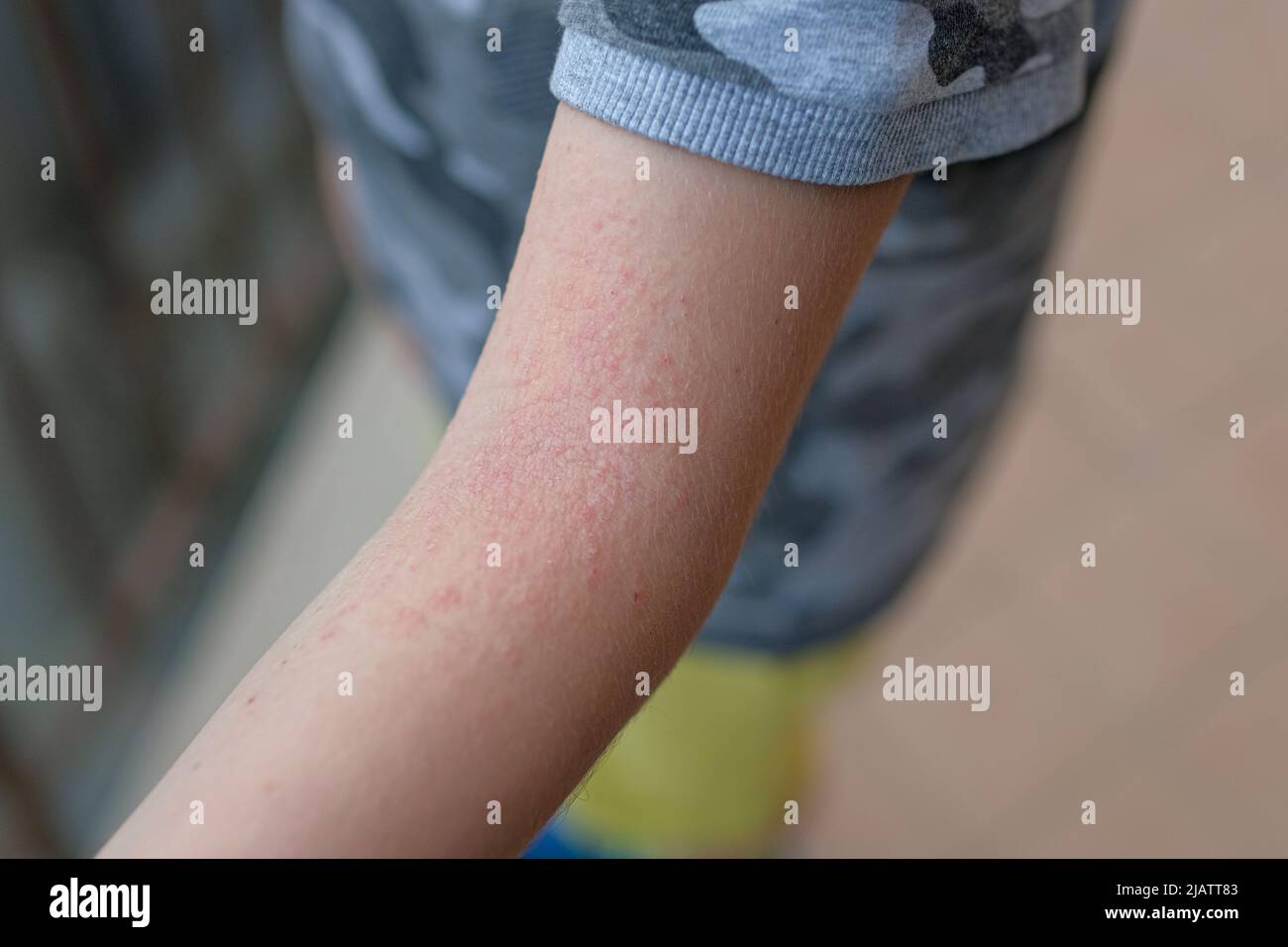 Kleiner Kinderarm mit atopischer Dermatitis-Ausschlag. Gesundheit Hautallergie Krankheit Stockfoto