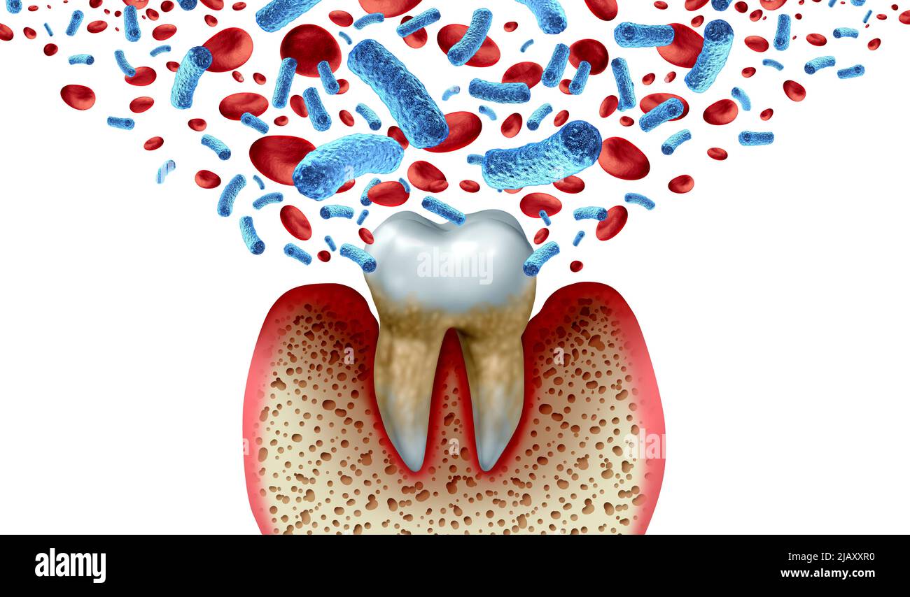 Karies und Blutbakterien und Krankheit als ungesunder Molar mit Parodontitis aufgrund schlechter Mundhygiene Gesundheitsproblem als bakterielle Infektion. Stockfoto