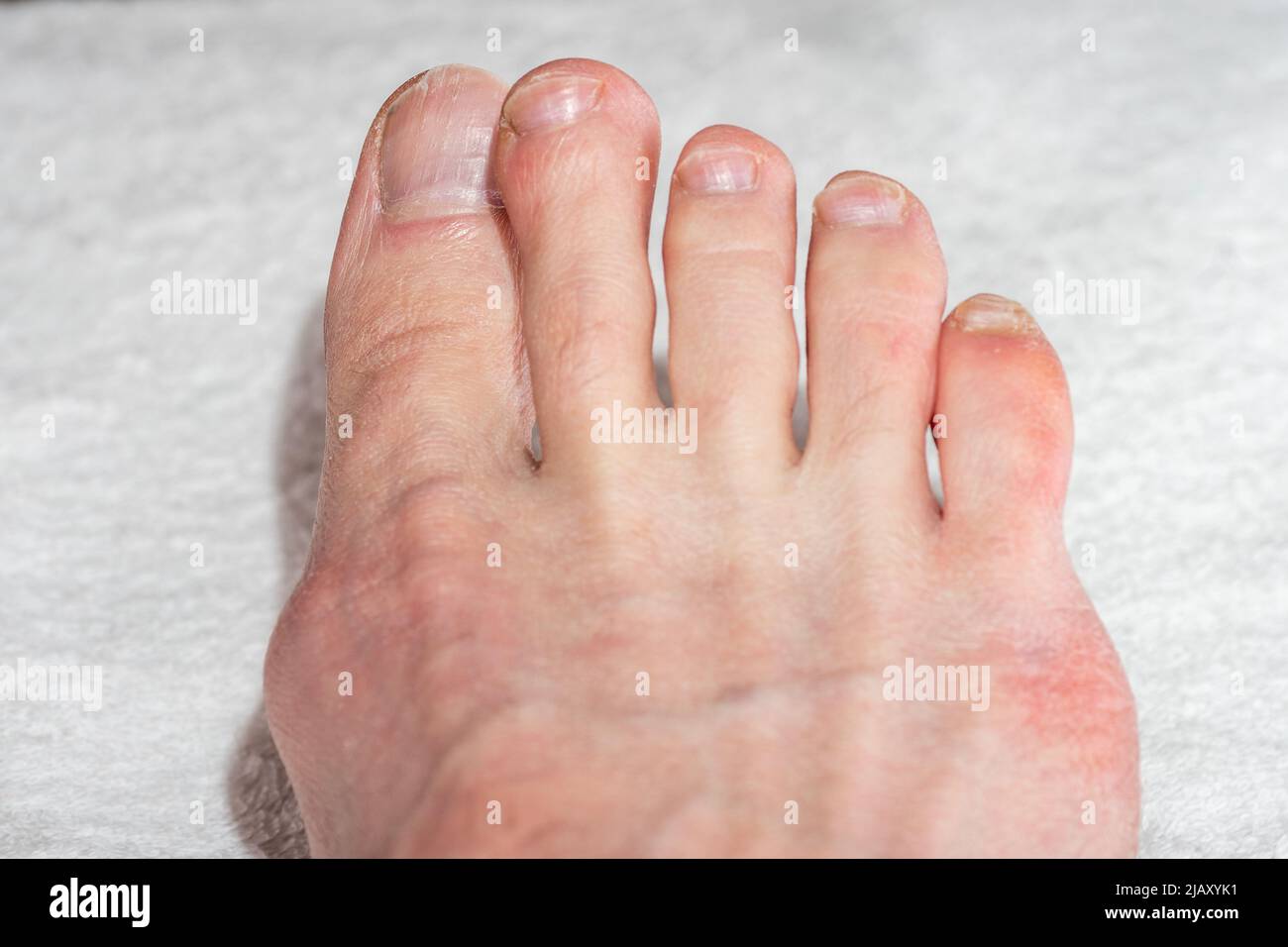 Weibliche Beine mit natürlichen gebrochenen Nägeln. Weibliche Beine mit schiefen Zehen und Bunion. Behandlung und Prävention von Hallux Valgus. Fußpflegekonzept Stockfoto