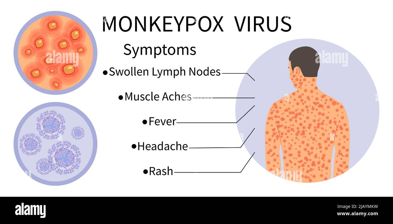 Monkeypox-Virus-Banner für Symptombewusstsein. Infografik zu Symptomen des Monkeypox-Virus. Menschlicher Körper mit Ausschlag. Symptome der Krankheit - geschwollene Lymphe Stock Vektor