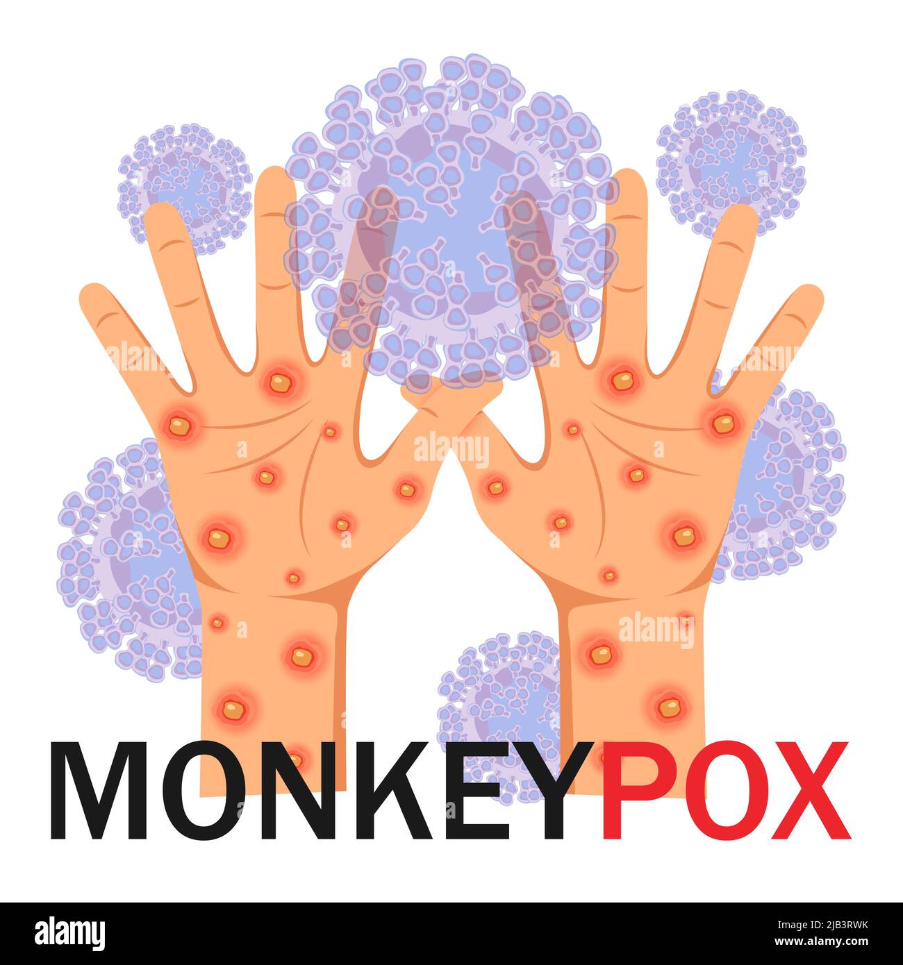 Monkeypox-Virus. Menschliche Hände mit Ausschlag auf mikrobiologischen Hintergrund mit Text. Monkeypox-Konzept. Vektorgrafik. Stock Vektor