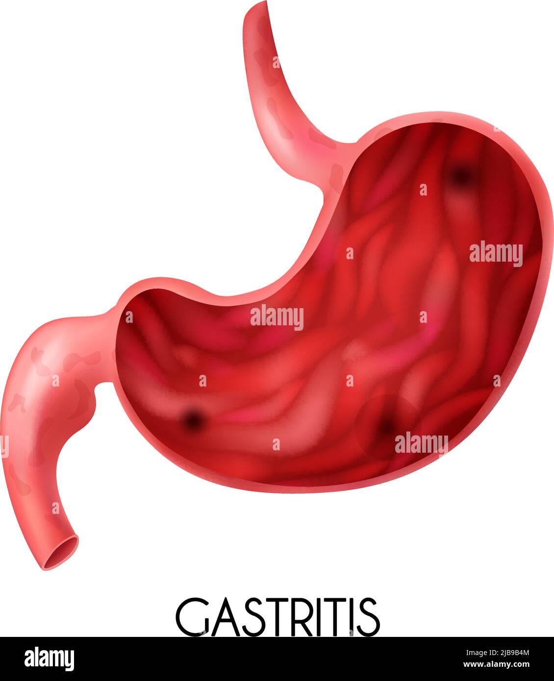 Realistisches medizinisches Bild des menschlichen Magens mit Gastritis auf weißem Hintergrund Vektorgrafik Stock Vektor