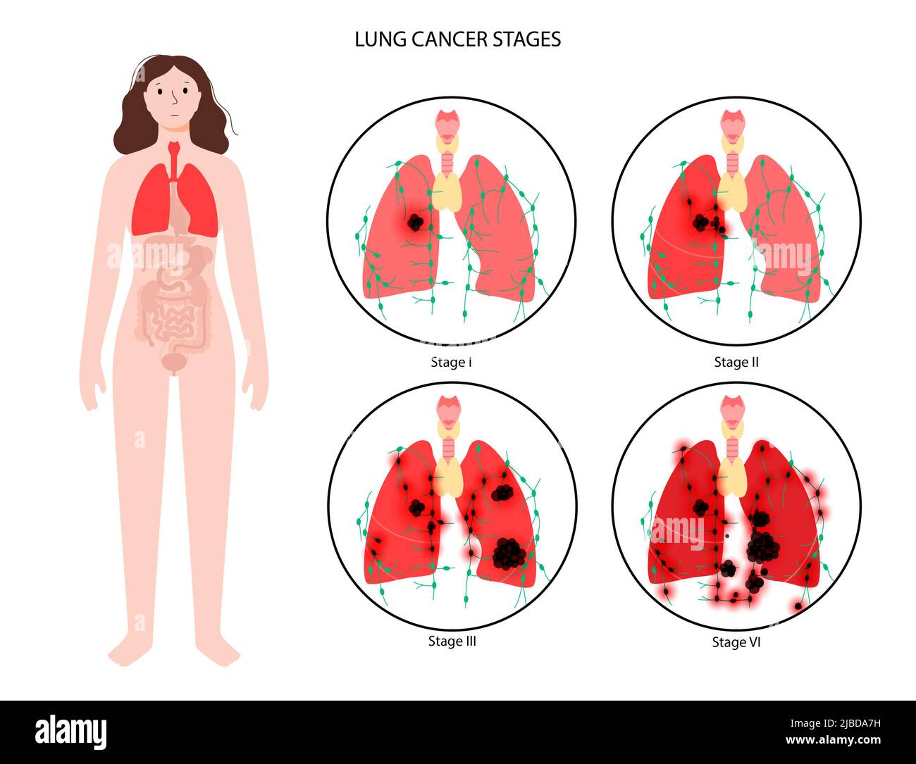 Stadien von Lungenkrebs, Abbildung Stockfoto
