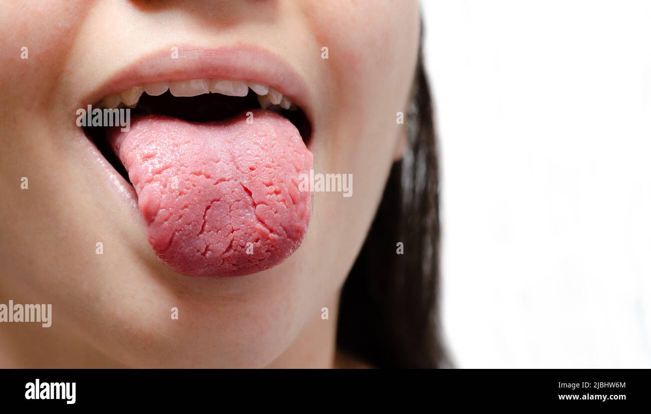 Zunge einer jungen kaukasischen Frau mit gutartiger Wanderglossitis. Ongue mit Candidiasis. Risse in der Zunge. Stockfoto