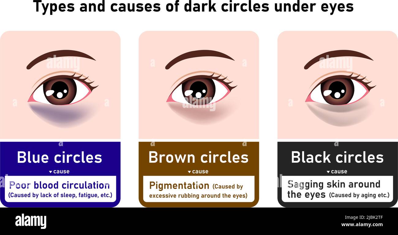 Arten und Ursachen von dunklen Kreisen unter den Augen. Vektorgrafik Stock Vektor