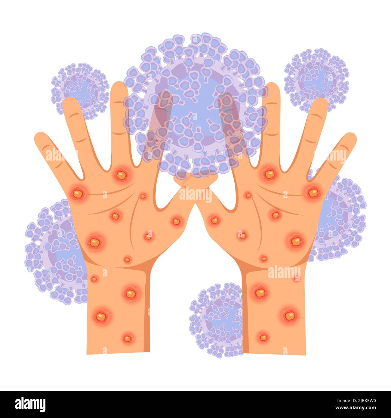 Virale Infektionskrankheit Monkeypox-Virus. Menschliche Hände, die von einem Hautausschlag betroffen sind, bedeckt mit eitrigen Geschwüren und Pickel. Vektorgrafik. Stock Vektor