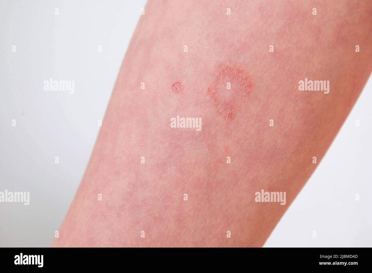 Das Kind hat allergische Kontaktdermatitis auf der Haut. Stockfoto