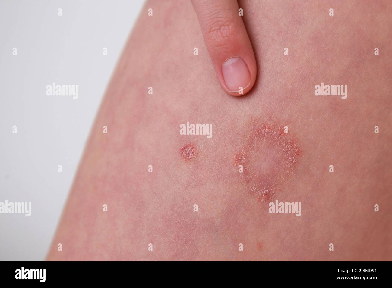 Das Kind hat allergische Kontaktdermatitis auf der Haut. Stockfoto