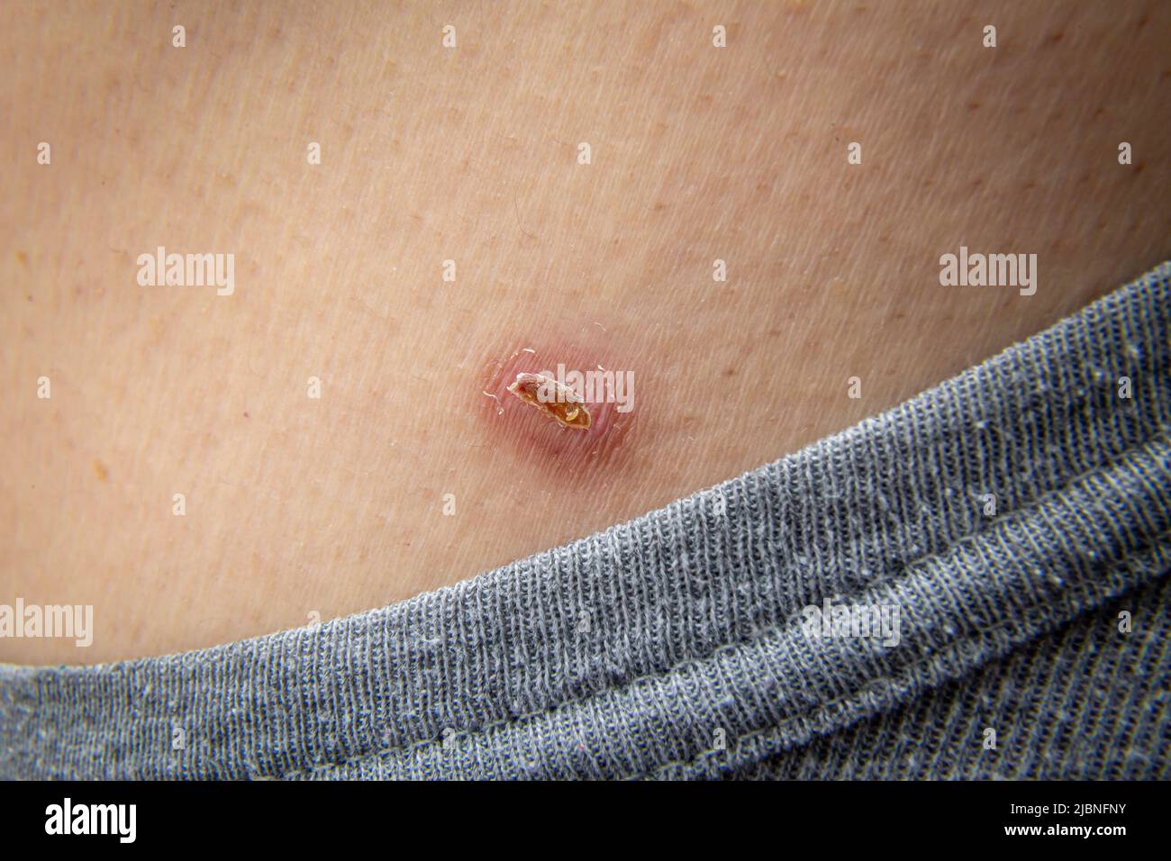 Kleine Narbe auf der Haut eines menschlichen Körpers nach der Behandlung mit flüssigem Stickstoff durch den medizinischen Dermatologen, um den Hautfleck oder den Hautmol zu entfernen. Hautmole Stockfoto