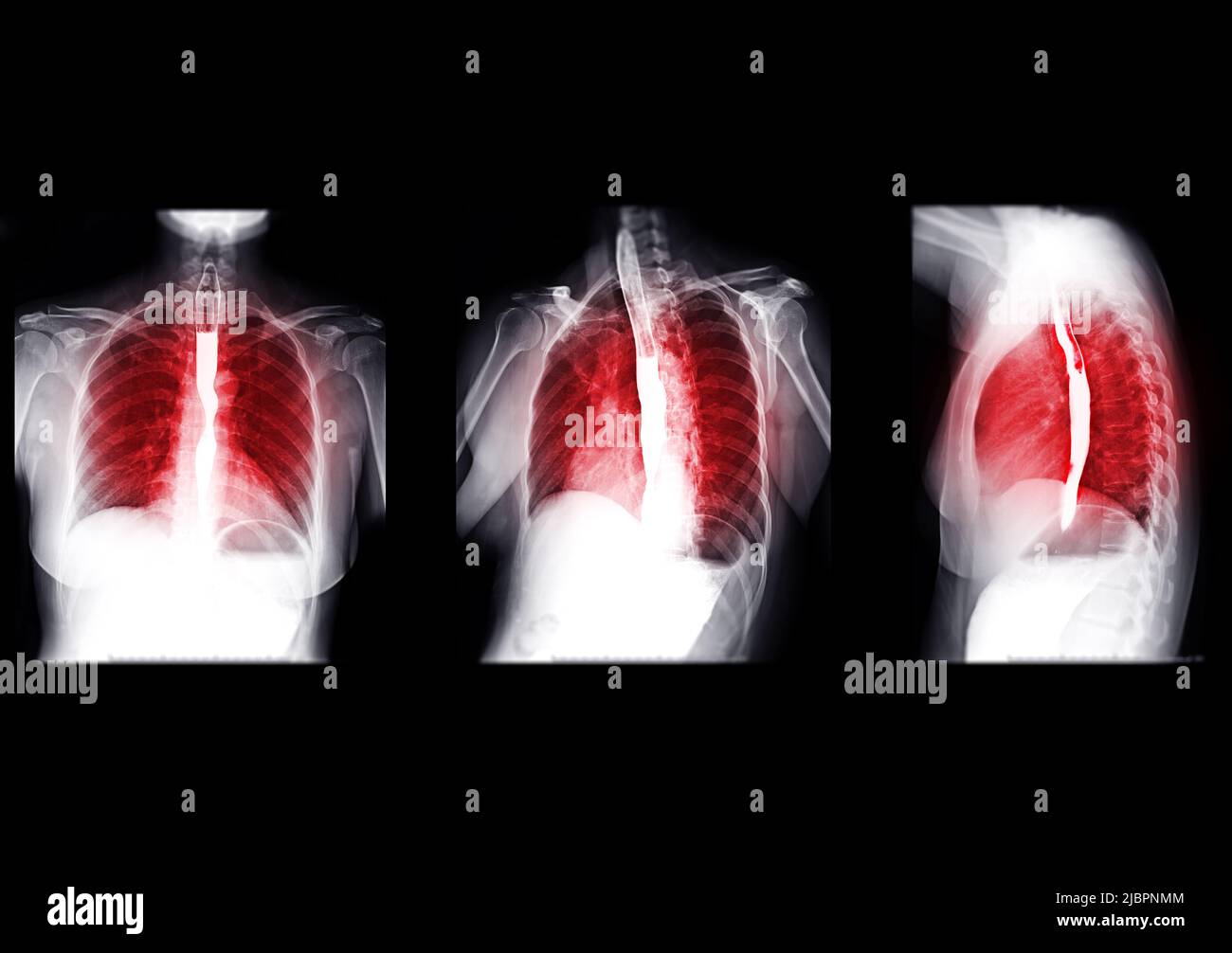 Sammlung von Esophagramm- oder Bariumschlucken mit Speiseröhre zur Diagnose GERD- oder gastroösophagealer Refluxkrankheit oder Ösophaguskrebs. Stockfoto