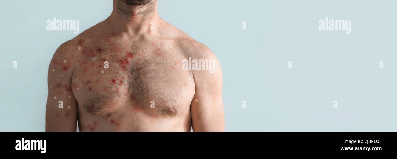 Männliche Brust durch Blasenausschlag wegen Monkeypox oder andere Virusinfektion auf weißem Hintergrund betroffen Stockfoto