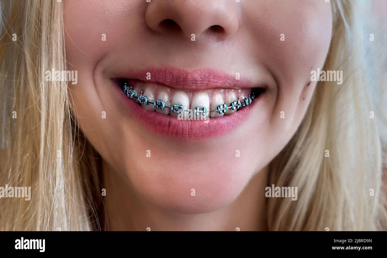 Zähne mit Zahnspangen. Zahnpflegekonzept. Nahaufnahme eines breiten Lächelns eines Mädchens mit Zahnspangen auf schneeweißen Zähnen. Das Konzept der Pflege von Zähnen und Mund Stockfoto