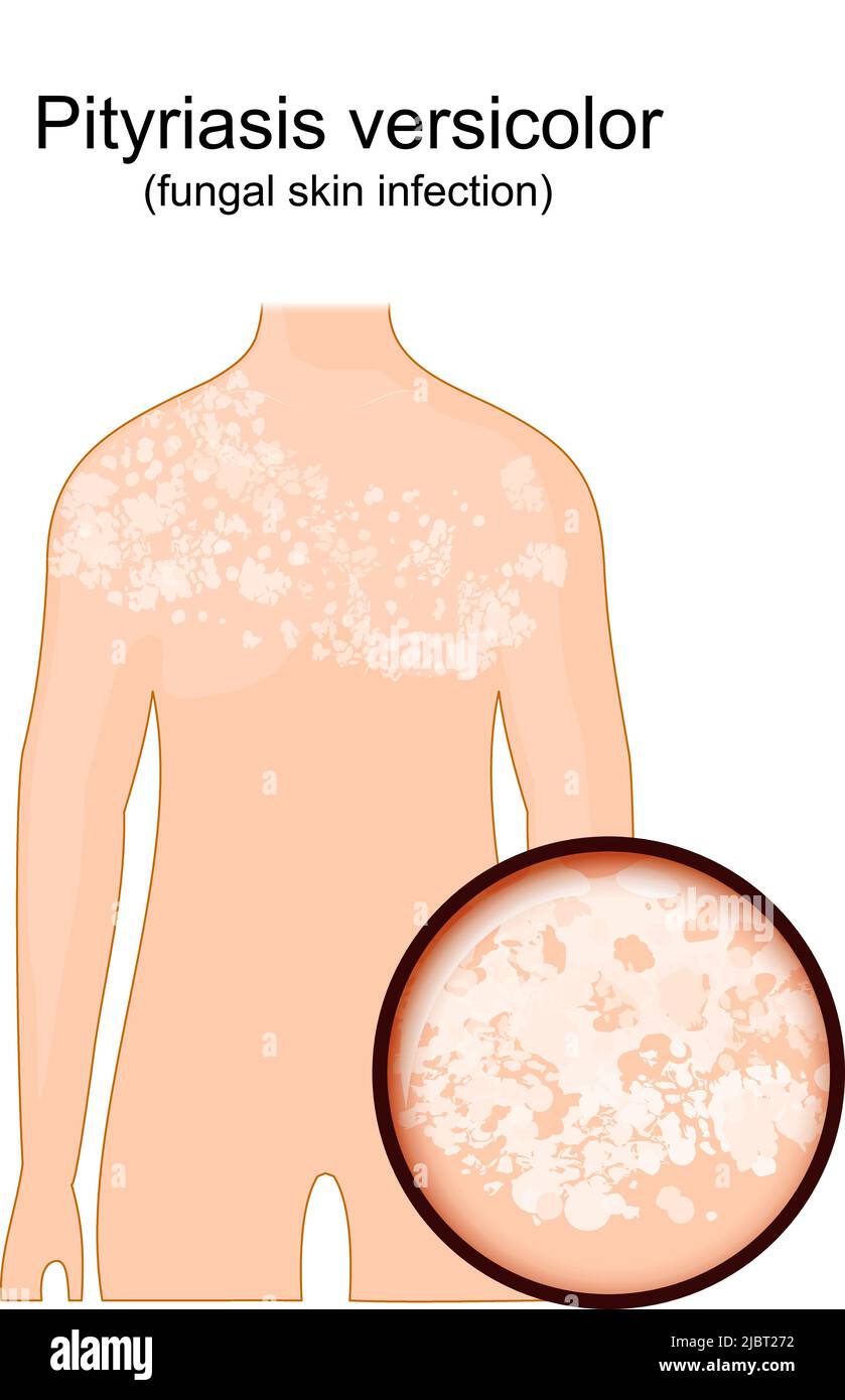 Tinea versicolor. Menschlicher Körper mit Symptomen einer Pityriasis versicolor. Nahaufnahme der Haut, die von einem Pilz betroffen. vektor-Illustration Stock Vektor