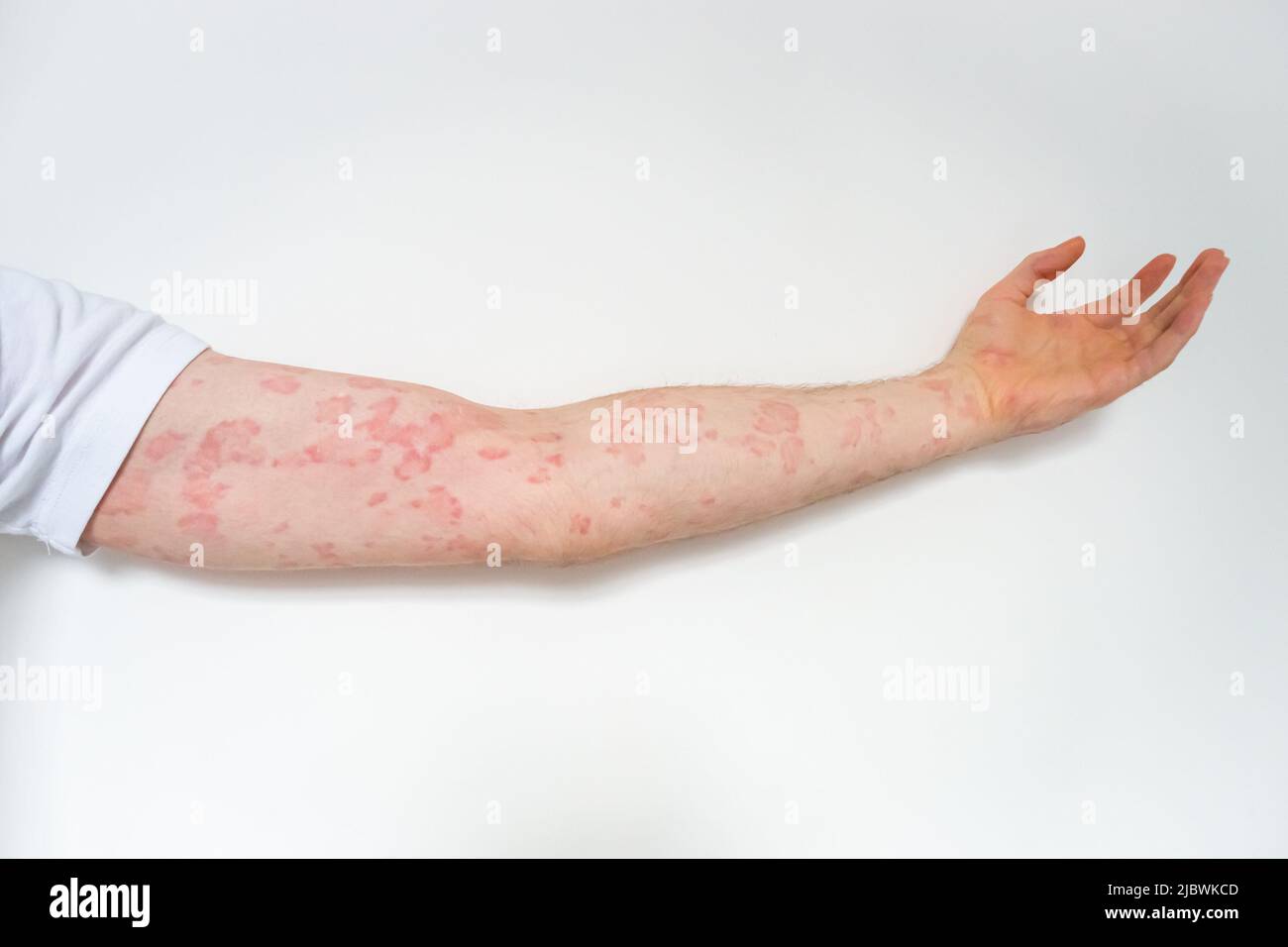 Das Foto zeigt den Arm eines Mannes mit chronischer Urtikaria oder Nesselsucht, einen Hautausschlag mit roten holprigen Schweißnähten, der juckend und manchmal schmerzhaft ist. Haut, Juckreiz, Juckreiz Stockfoto