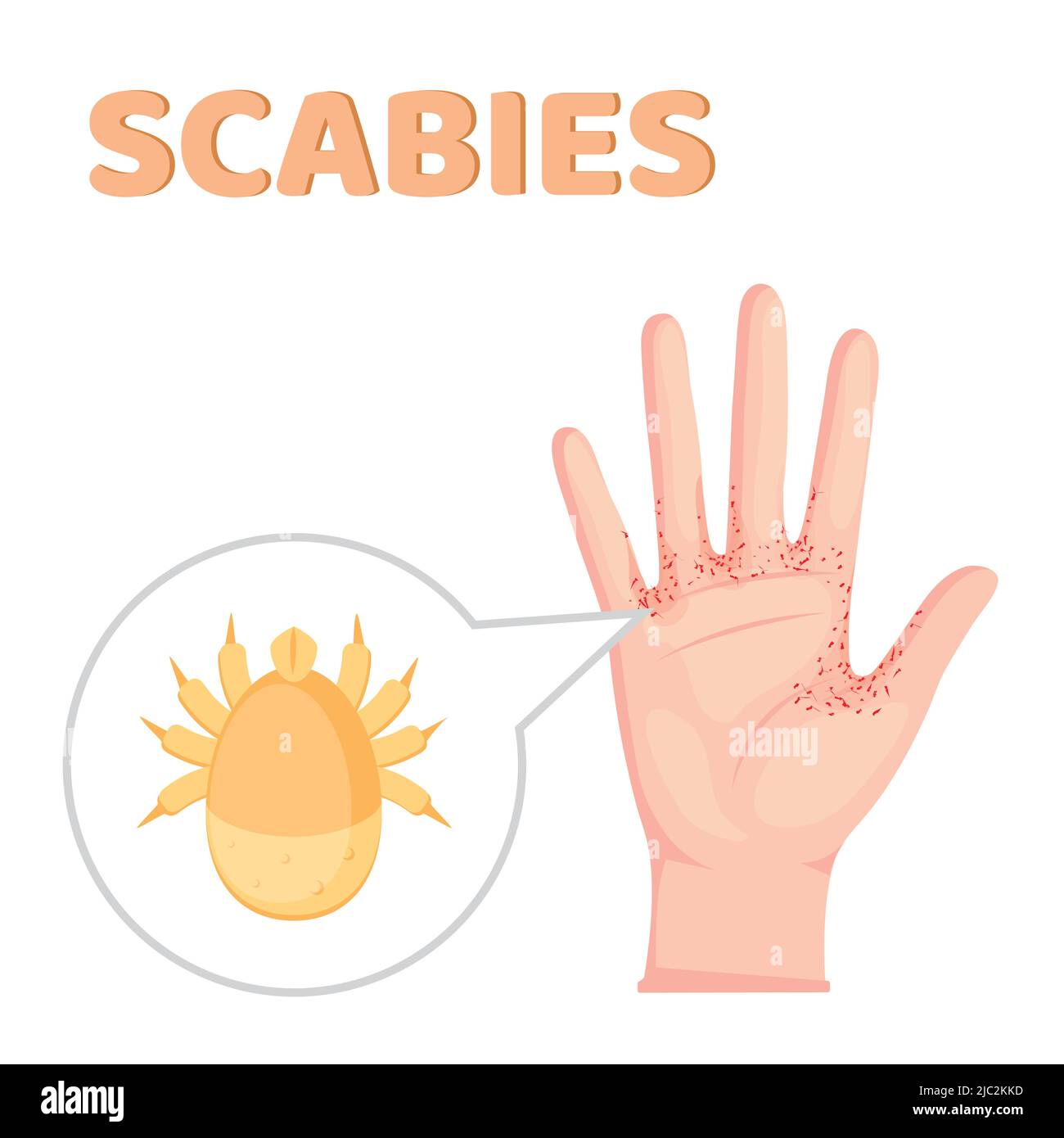 Sarcoptes scabiei. Scabies. Sexuell übertragbare Krankheit. Infografiken. Illustration auf isoliertem Hintergrund. Stock Vektor