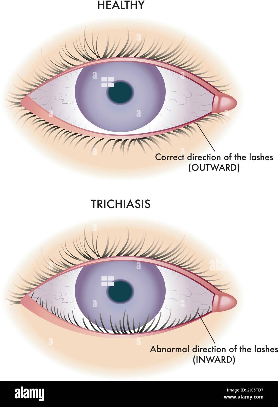 Die medizinische Illustration zeigt den Vergleich zwischen einem normalen Auge und einem von Trichiasis betroffenen Auge. Stock Vektor