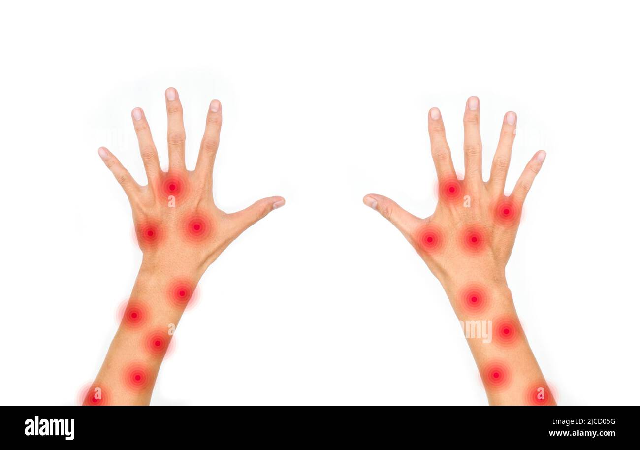Monkeypox-Haut rascht über beide Arme des asiatischen jungen Mannes. Isoliert auf Weiß. Stockfoto Monkeypox-Haut rascht über beide Arme des asiatischen jungen Mannes. Isoliert auf Weiß. Stockfoto
