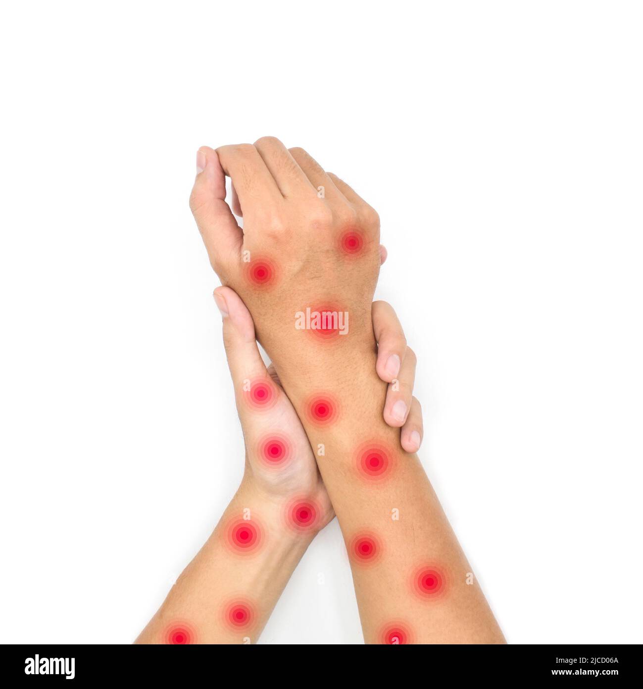 Monkeypox-Haut rascht über beide Arme des asiatischen jungen Mannes. Isoliert auf Weiß. Stockfoto Monkeypox-Haut rascht über beide Arme des asiatischen jungen Mannes. Isoliert auf Weiß. Stockfoto