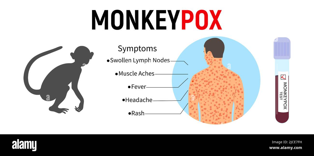 Banner mit einer Silhouette eines Affen, einem Reagenzglas für Blut, mit einem Text der Symptome von Monkeypox und einem menschlichen Körper mit einem Ausschlag. Konzept eines Virus Stock Vektor