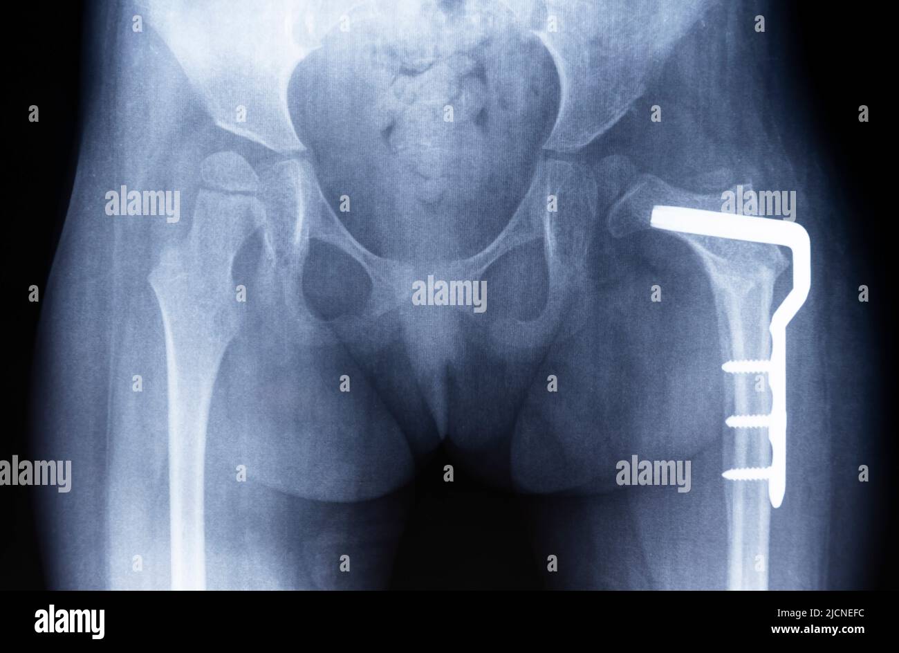 Osteotomie des Hüftgelenks. Die Film-Röntgenaufnahme des Beckens zeigt Dysplasie des linken Oberschenkels, Metallplatte. Stockfoto