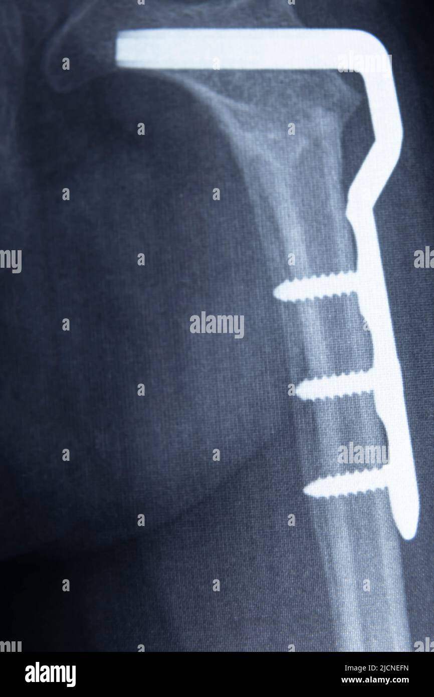 Hüftosteotomie. Film-Röntgenaufnahme des Beckens: Dysplasie des linken Oberschenkels, Metallplatte aus der Nähe. Stockfoto