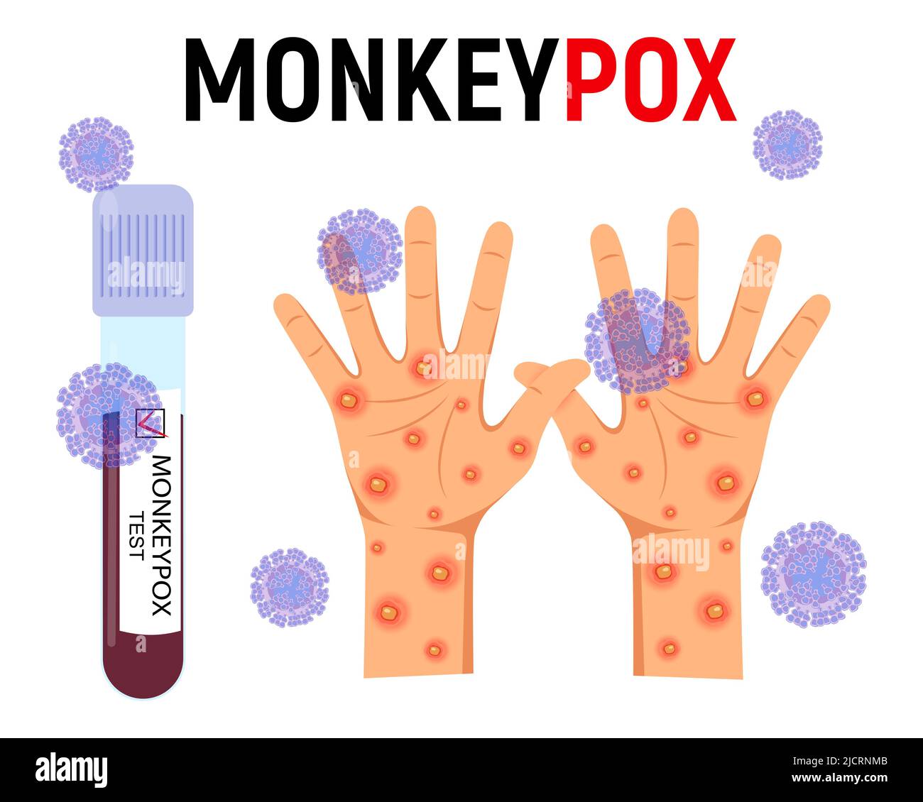 Affenpocken Hintergrund. Ein Reagenzglas mit Blut für einen Test und eine menschliche Hand mit einem Ausschlag und Geschwüren, umgeben von Viruszellen auf weißem Hintergrund Stock Vektor