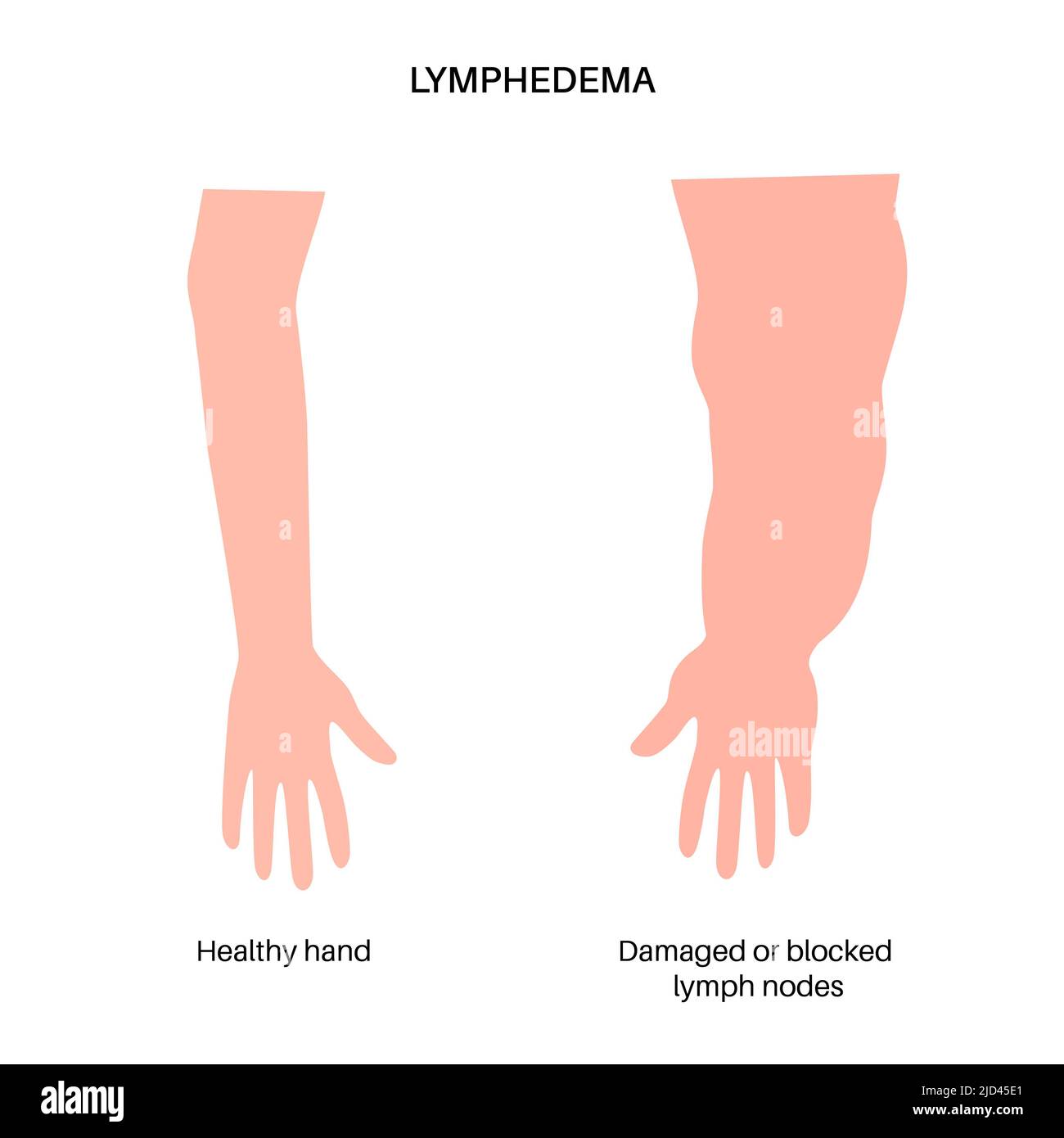 Lymphodem des Arms, Illustration Stockfoto