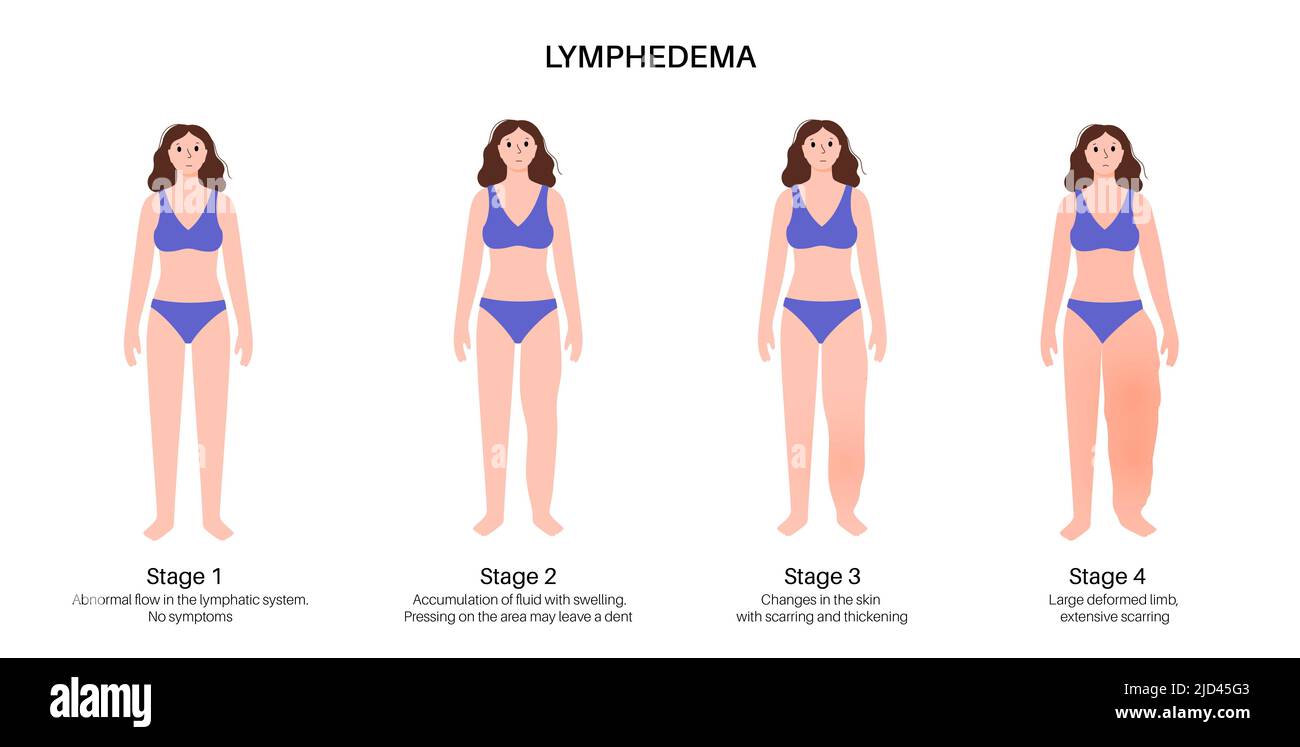 Stadien des Lymphodems, Illustration Stockfoto