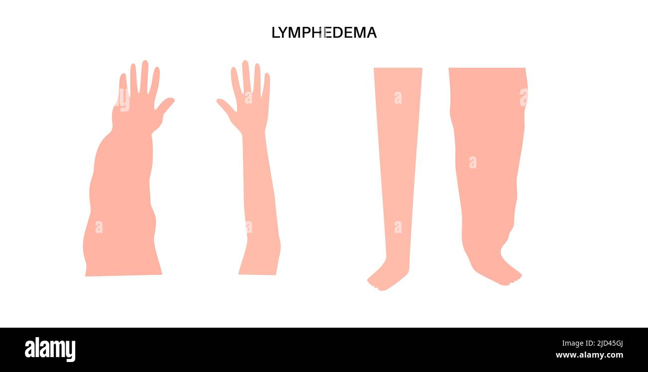 Lymphodem von Arm und Bein, Illustration Stockfoto