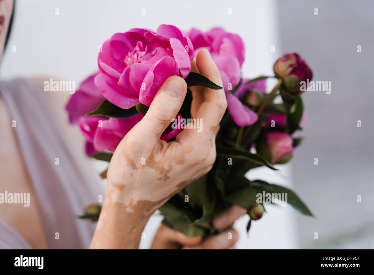 Hände mit Vitiligo Hautpigmentierung und Blumenstrauß Pfingstrosen. Saisonale Hauterkrankungen Stockfoto