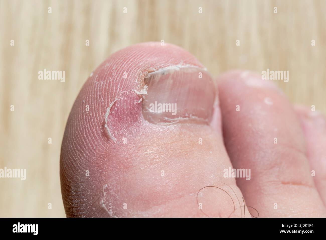 Nahaufnahme der Zehe auf einem Fuß einer Person, die Fußhaut des Athleten hat Stockfoto