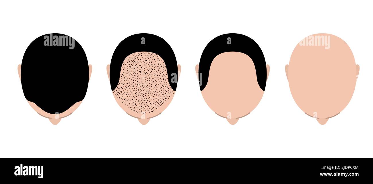 Haarausfall Glatzenkopf Alopezie Transplantation Wachstumsvektor Draufsicht. Haarausfall Männer Draufsicht Alopezie Kopfhautproblem Stock Vektor