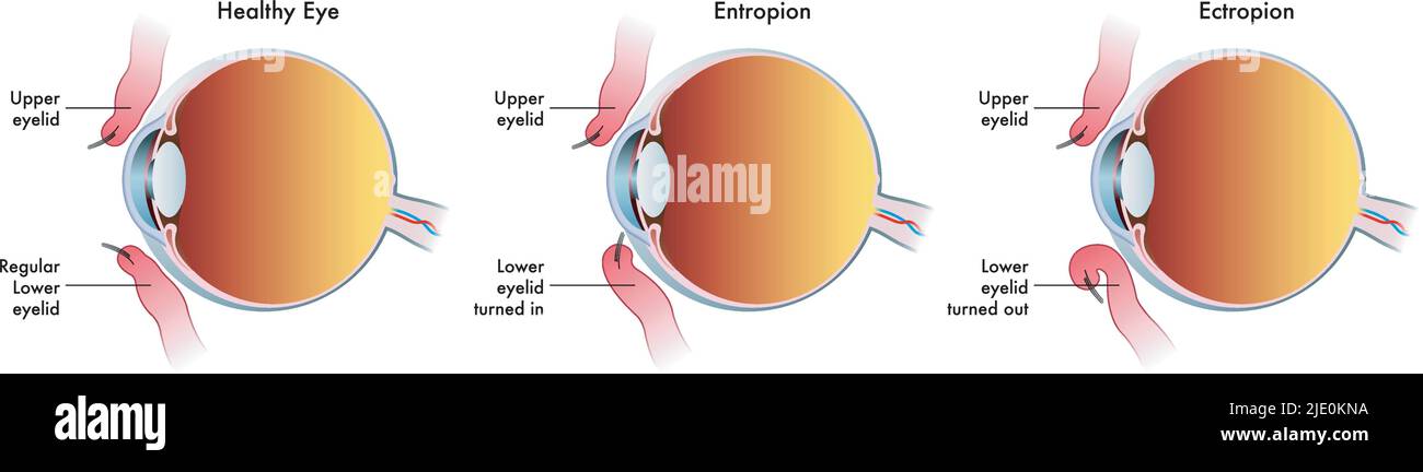 Die medizinische Illustration zeigt den Vergleich zwischen einem normalen Auge, einem von Entropium und einem anderen von Ektropium betroffen. Stock Vektor