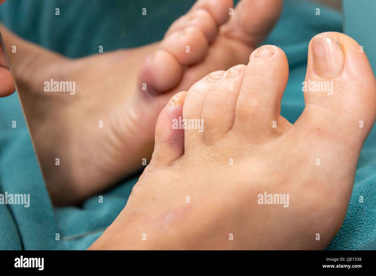 Gebrochene und gequetschte kleine Zehe durch Blutvergießen Stockfoto