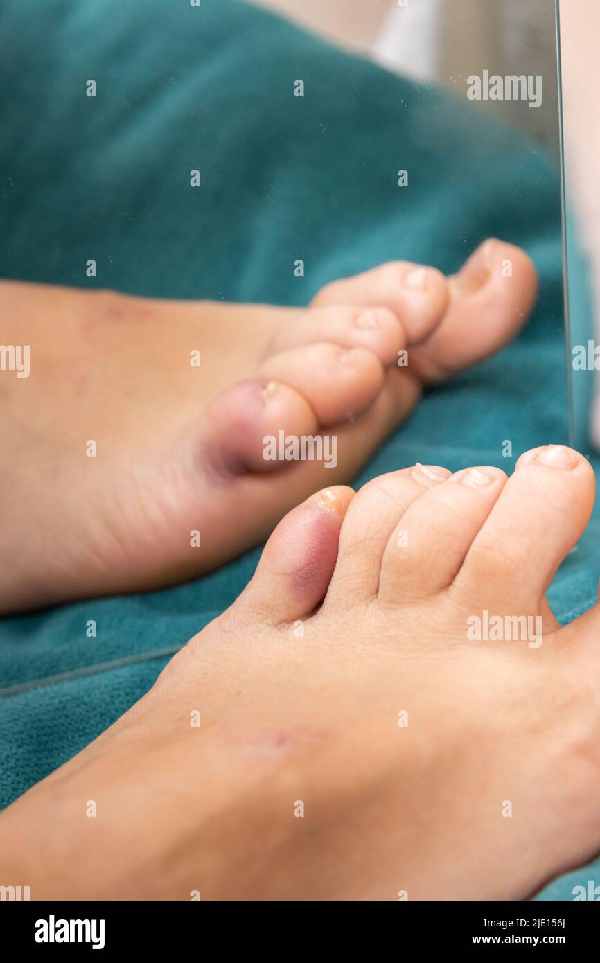 Gebrochene und gequetschte kleine Zehe durch Blutvergießen Stockfoto