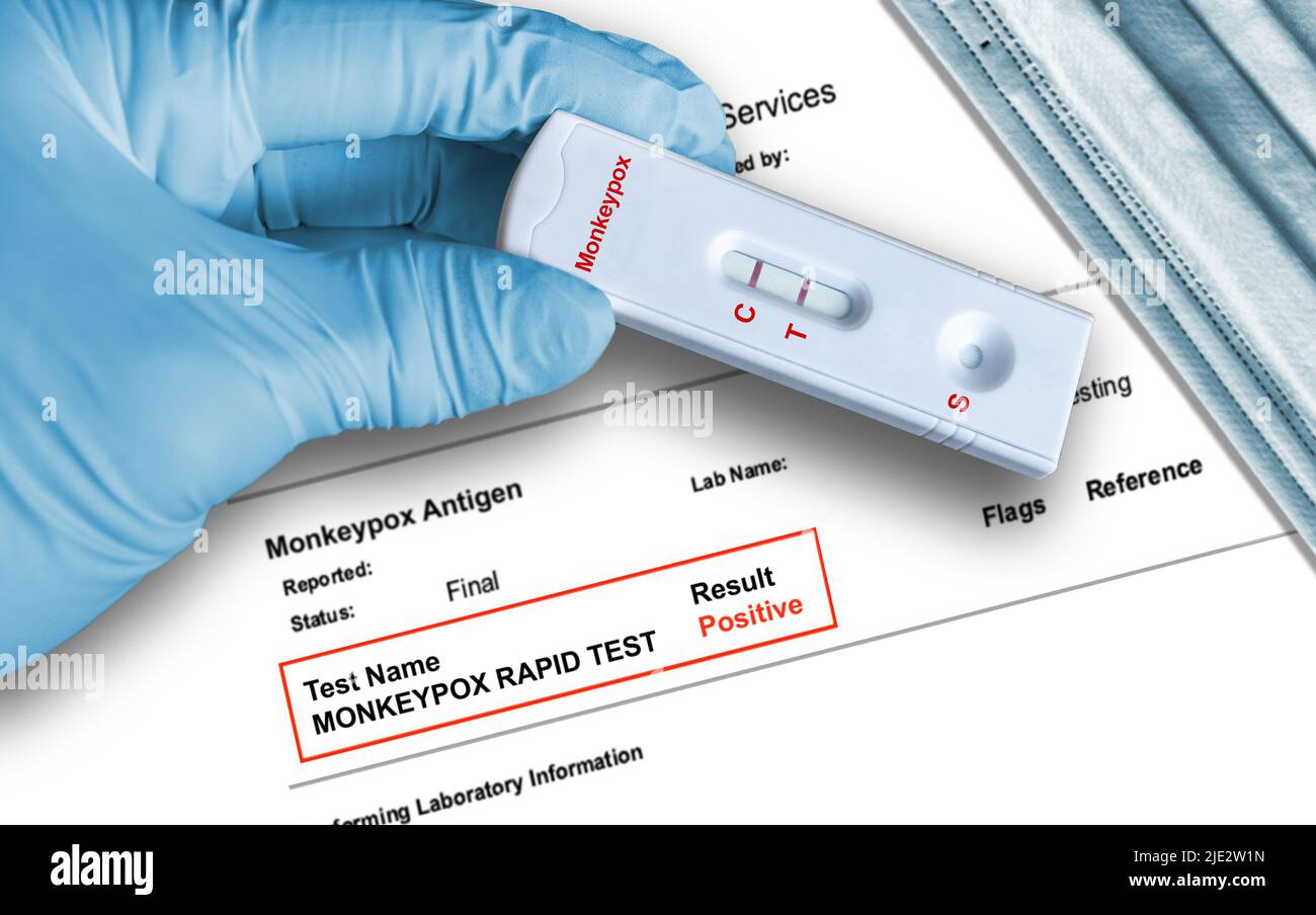 Monkeypox-positives Testergebnis durch Verwendung eines Schnelltestgeräts, das von Hand in einem medizinischen Handschuh mit medizinischer Gesichtsmaske im Hintergrund gehalten wird. Monkeypox-Testerkennung Stockfoto