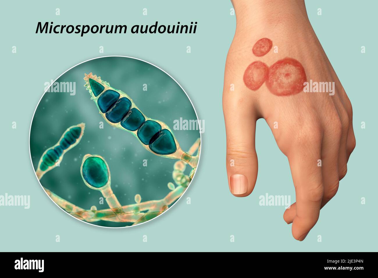 Pilzinfektion an der Hand eines Mannes, Illustration. Bekannt als Ringwurm-Infektion oder Tinea manuum. Es kann durch verschiedene Pilze, einschließlich Microsporum audouinii, verursacht werden. Es verursacht starken Juckreiz. Die Krankheit ist hochansteckend und kann durch direkten Kontakt oder durch Kontakt mit kontaminiertem Material verbreitet werden. Die Behandlung erfolgt mit Antimykotika. Stockfoto