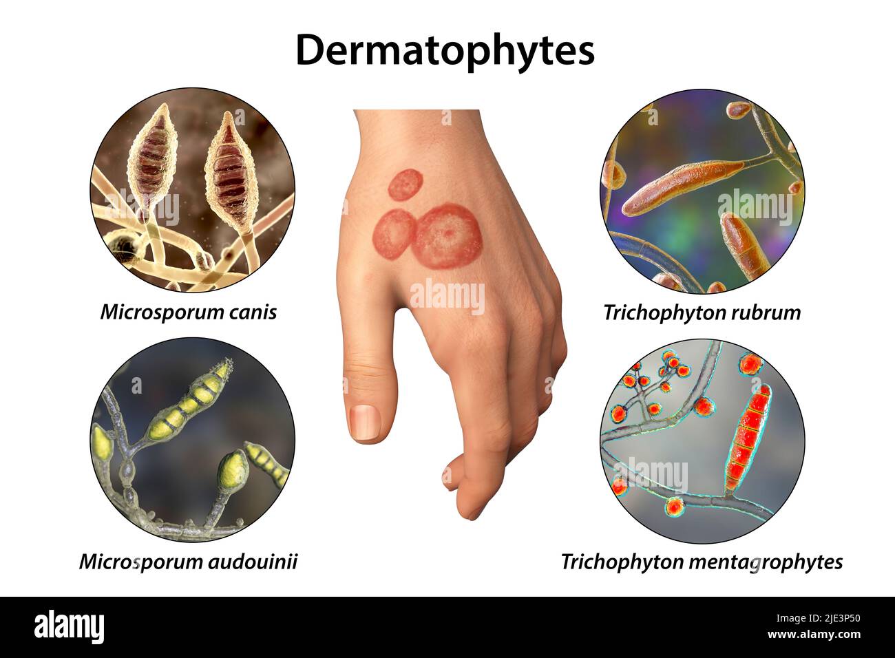 Pilzinfektion an der Hand eines Mannes, Illustration. Bekannt als Ringwurm-Infektion oder Tinea manuum. Es kann durch verschiedene Pilze verursacht werden, darunter Microsporum canis, Microsporum audouinii, Trichophyton rubrum und Trichophyton mentagrophytes. Es verursacht starken Juckreiz. Die Krankheit ist hochansteckend und kann durch direkten Kontakt oder durch Kontakt mit kontaminiertem Material verbreitet werden. Die Behandlung erfolgt mit Antimykotika. Stockfoto